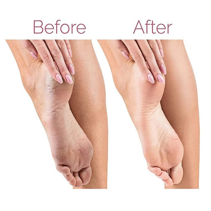 Electric Foot File – Callus Remover